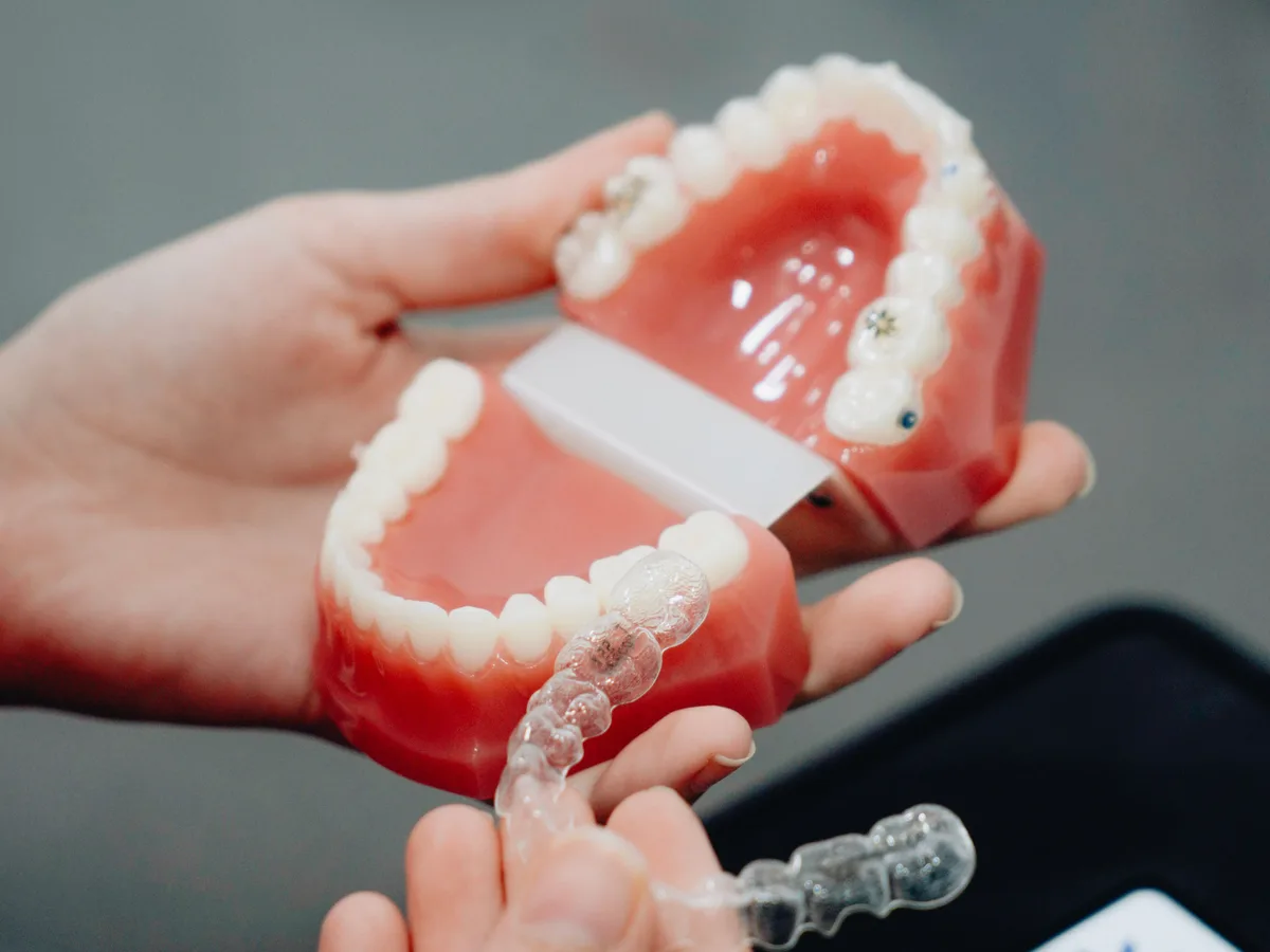 Dental model with a clear orthodontic appliance used during treatment planning.